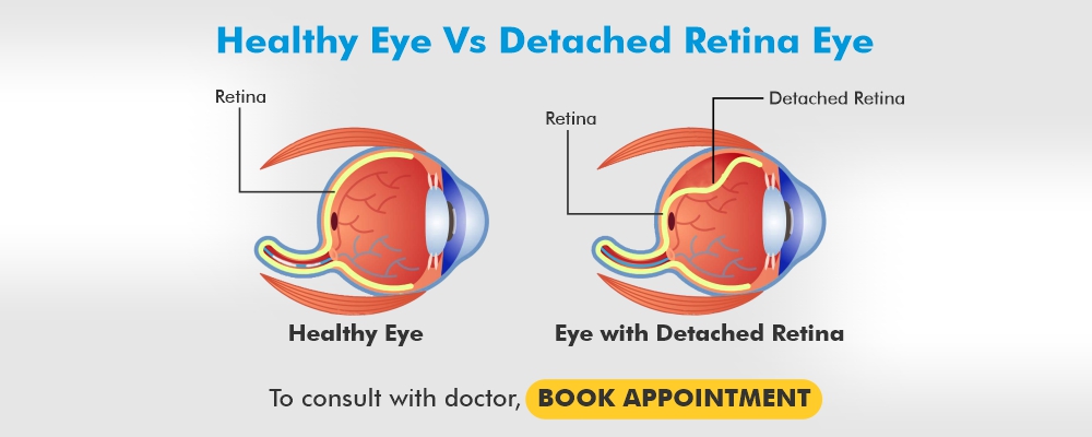 What Causes Retinal Detachment?