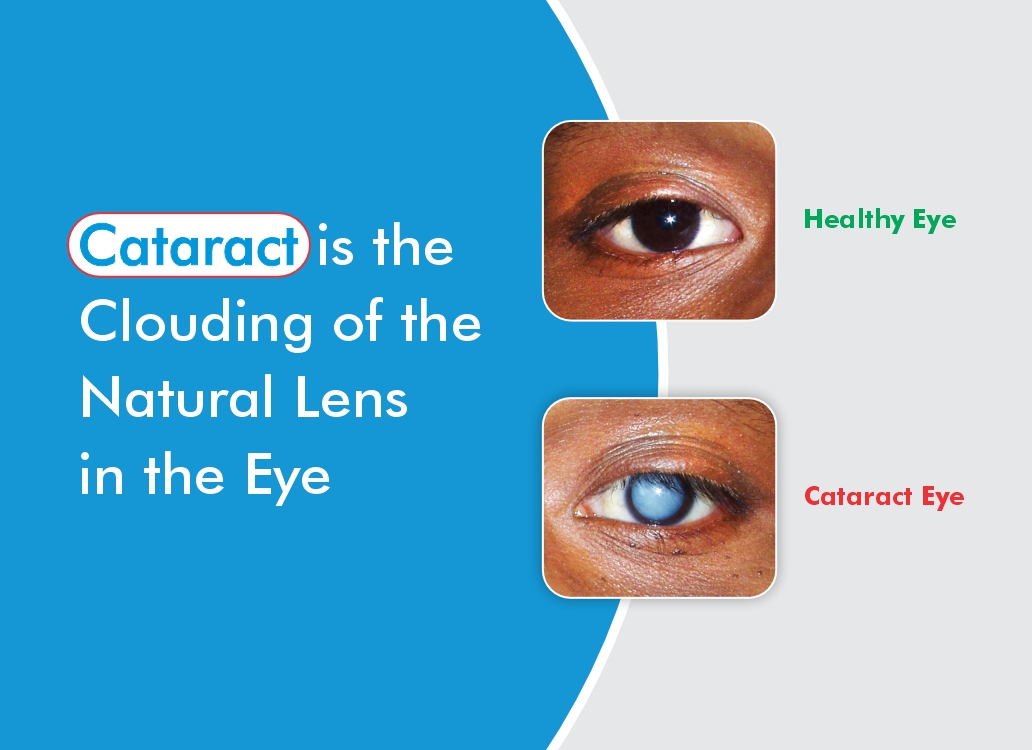 What are the Causes or Reasons of Cataract / Motiyabind?