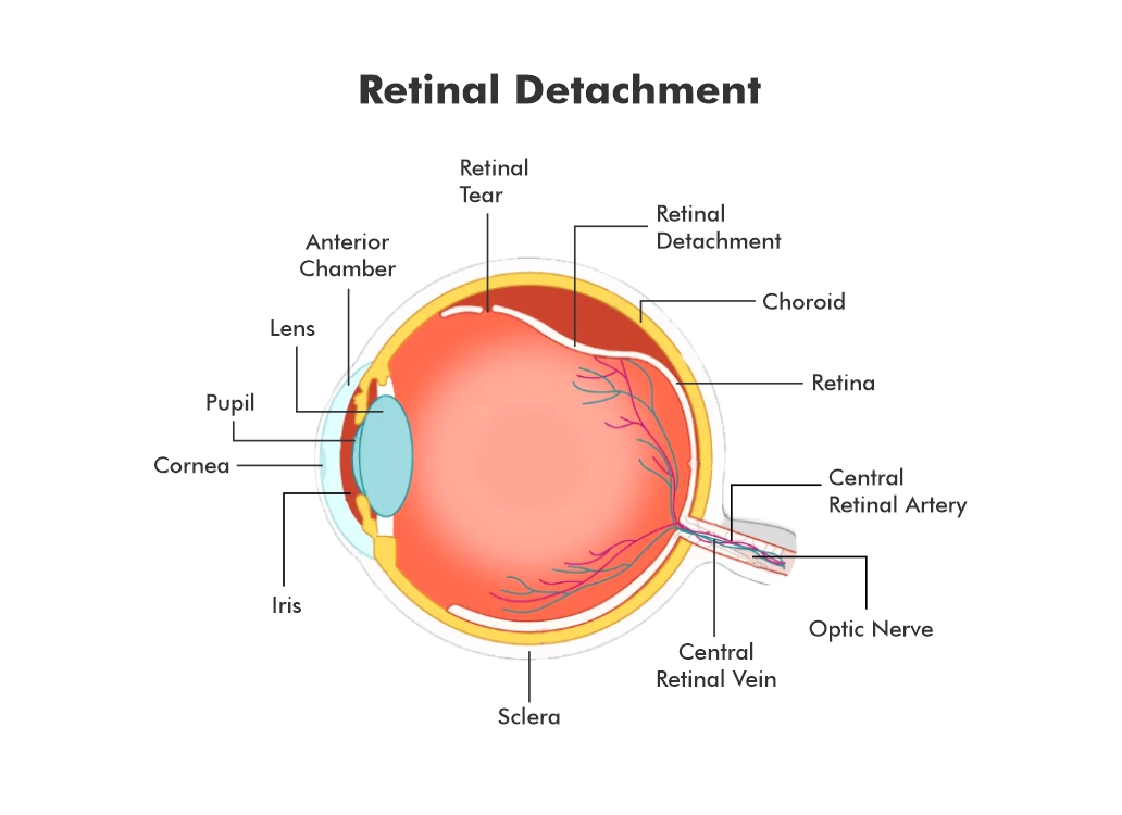 Retinal Detachment  Symptoms, Causes & Treatment