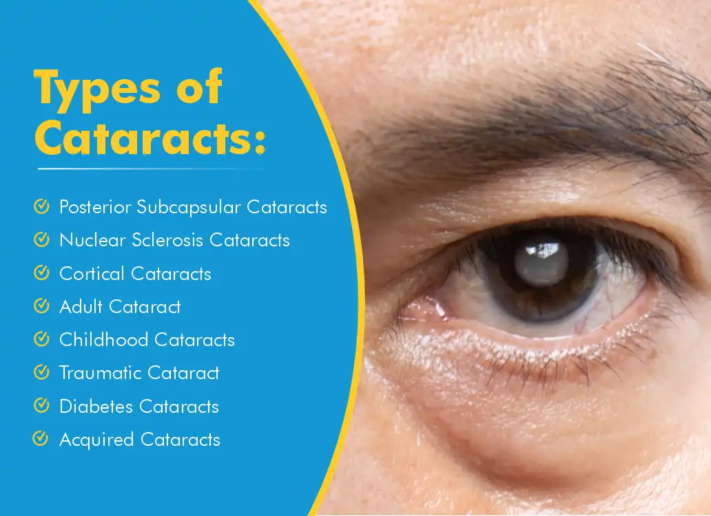 Common Types Of Cataracts Risks Prevention And Treatment