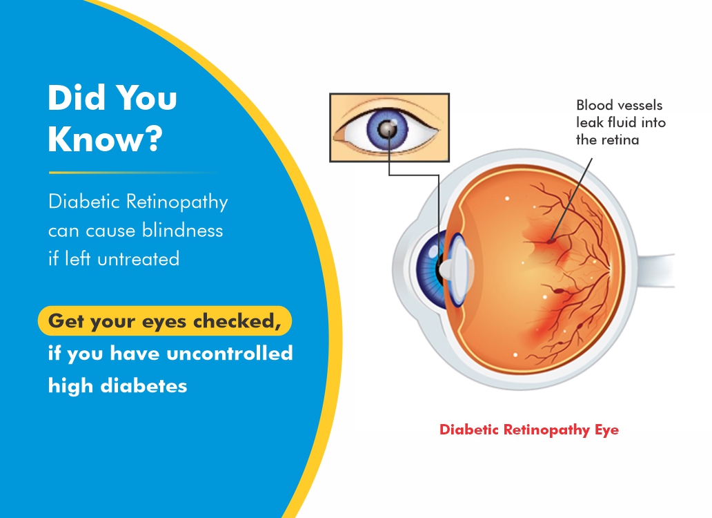 Diabetic Retinopathy Treatment Options Faqs And Expert Advice 