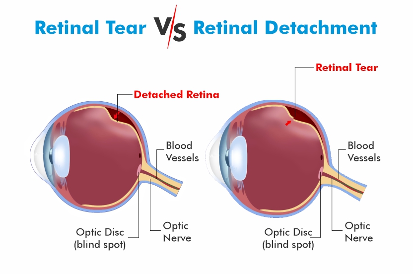 What Causes Retinal Detachment?